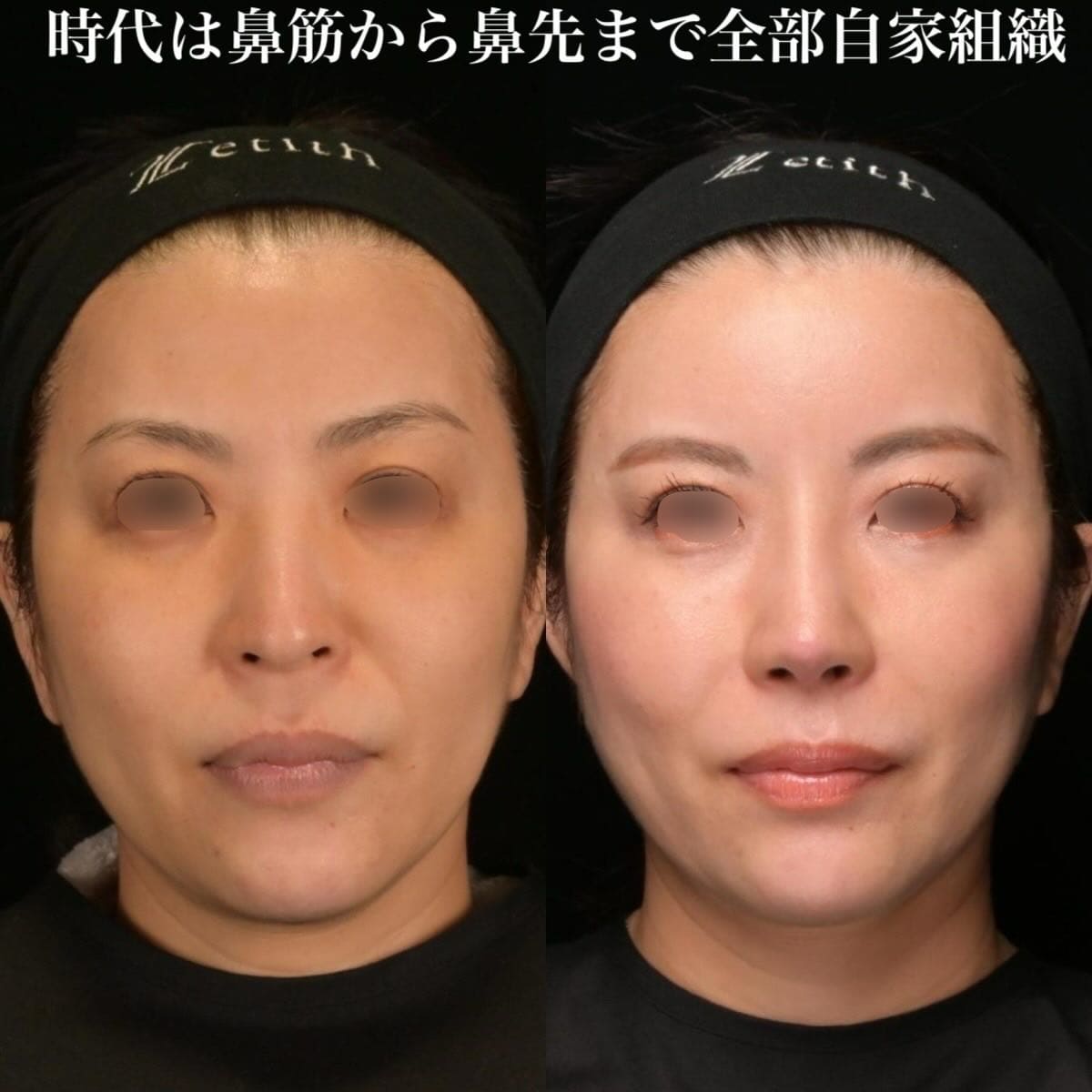 鉄医師による鼻整形の術前/術後ヶ月