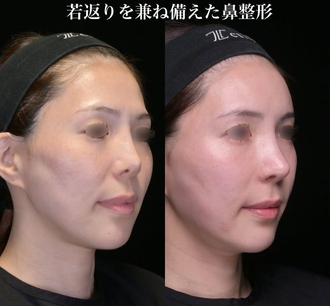 鉄医師による鼻整形の術前/術後3ヶ月 Дараа 
