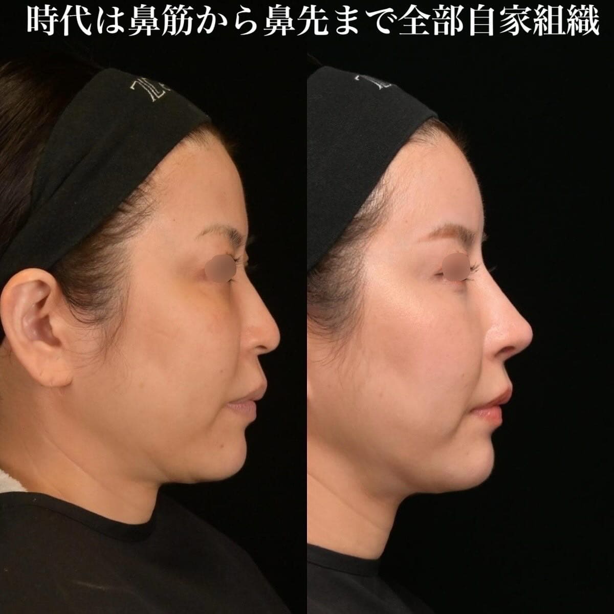 鉄医師による鼻整形の術前/術後ヶ月 Sonra 