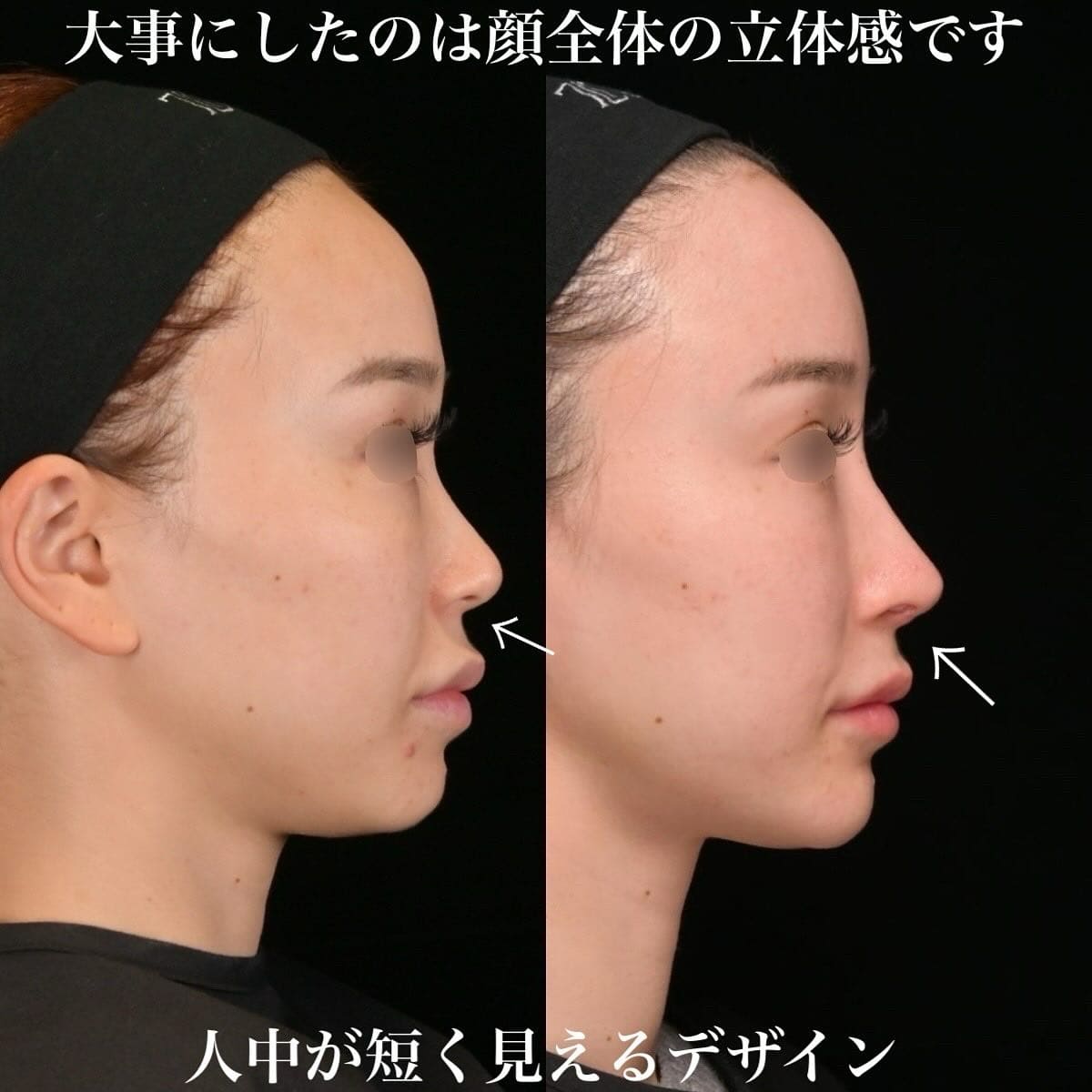 鉄医師による鼻整形の術前/術後３ヶ月 施術後 
