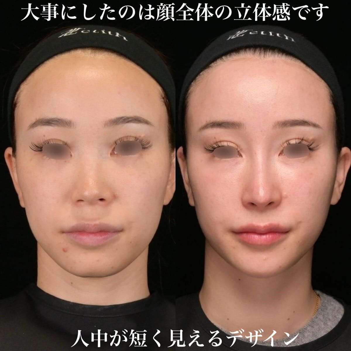 鉄医師による鼻整形の術前/術後３ヶ月