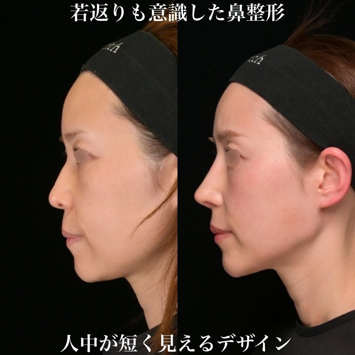 鉄医師による鼻整形の術前/術後３ヶ月 施術後 
