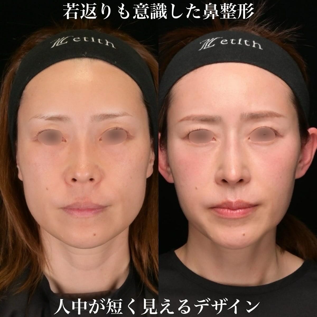 鉄医師による鼻整形の術前/術後３ヶ月