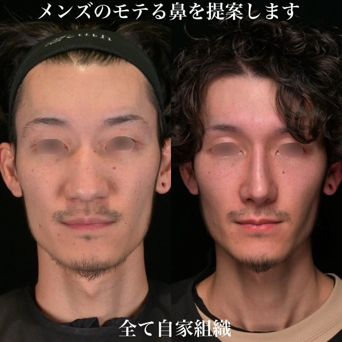 鉄医師による鼻整形の術前/術後３ヶ月
