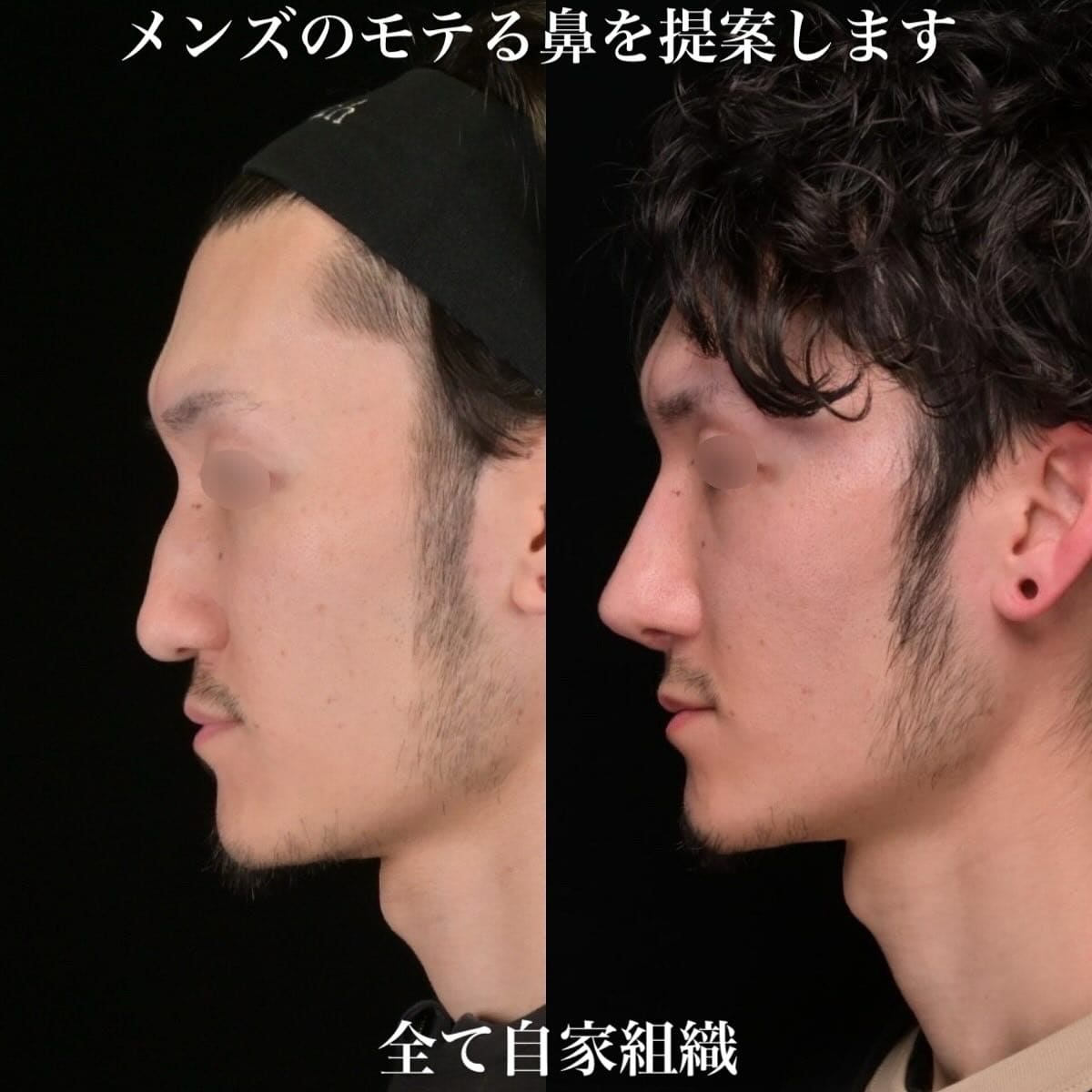 鉄医師による鼻整形の術前/術後３ヶ月 术后 