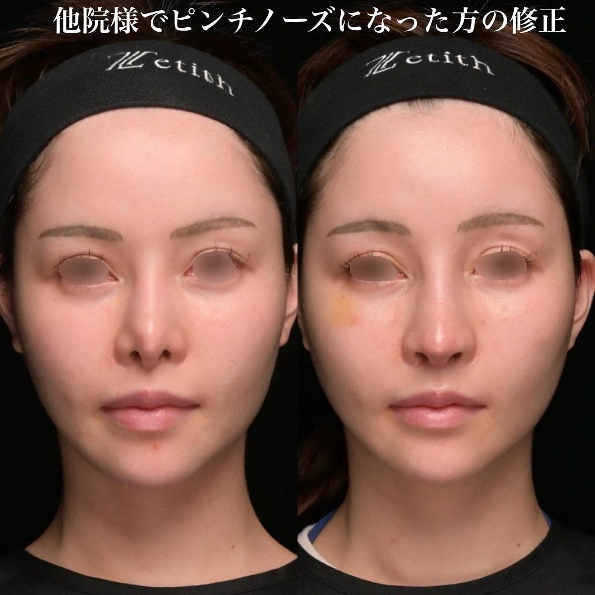 鉄医師による鼻整形の術前/術後2週間