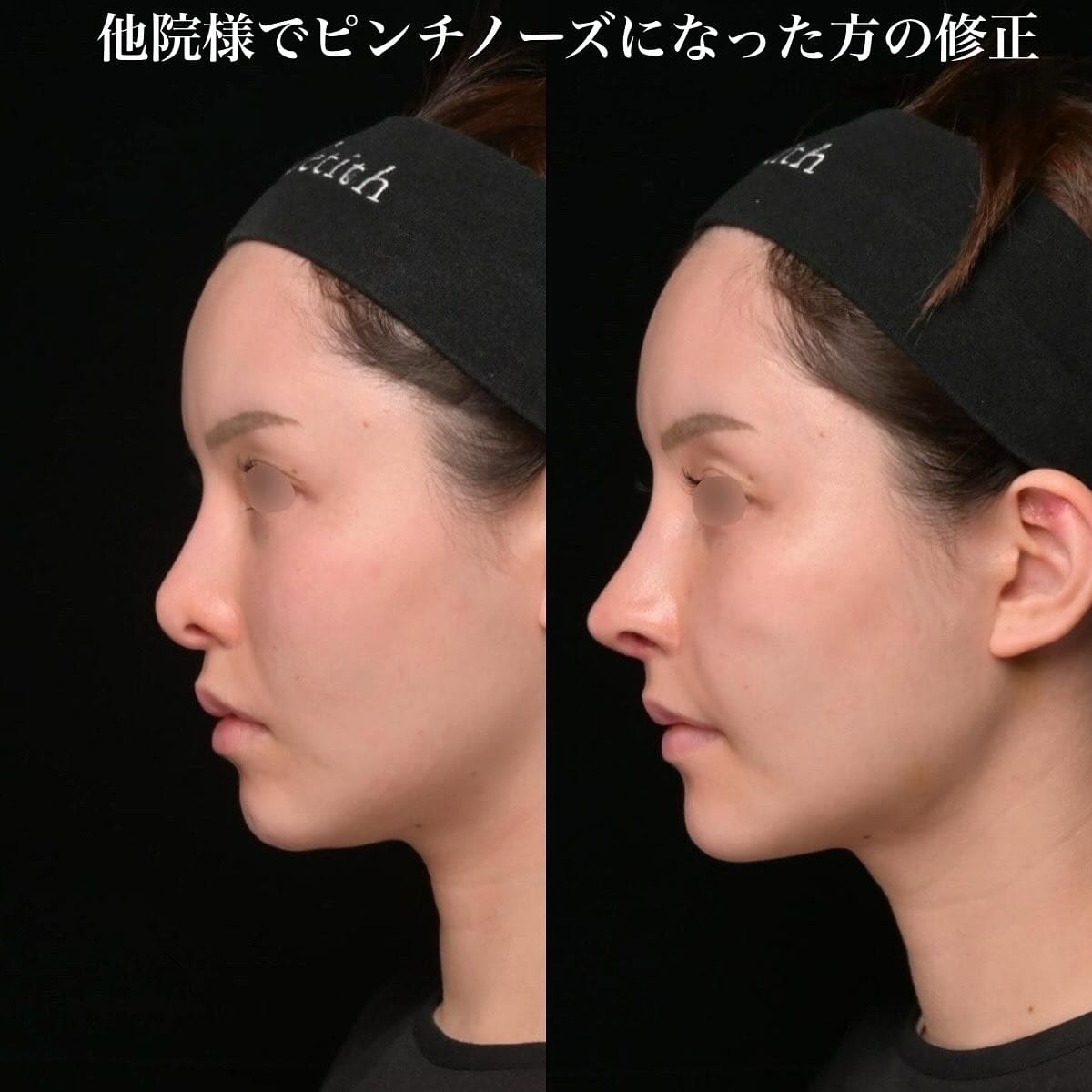 鉄医師による鼻整形の術前/術後2週間 术后 