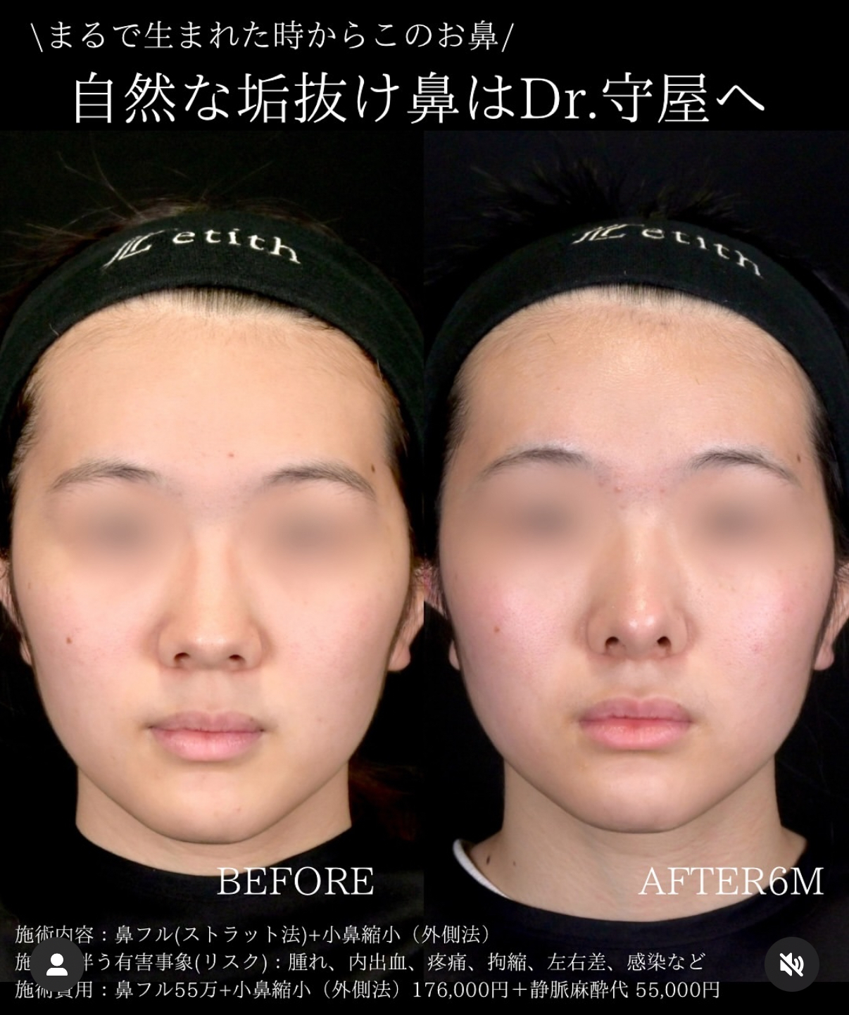 守屋医師による鼻整形の術前/術後6ヶ月