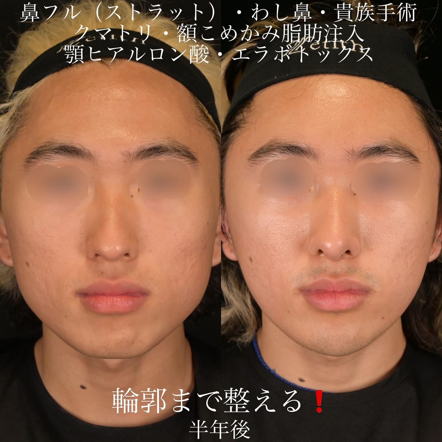 上木原医師による鼻整形の術前/術後6ヶ月