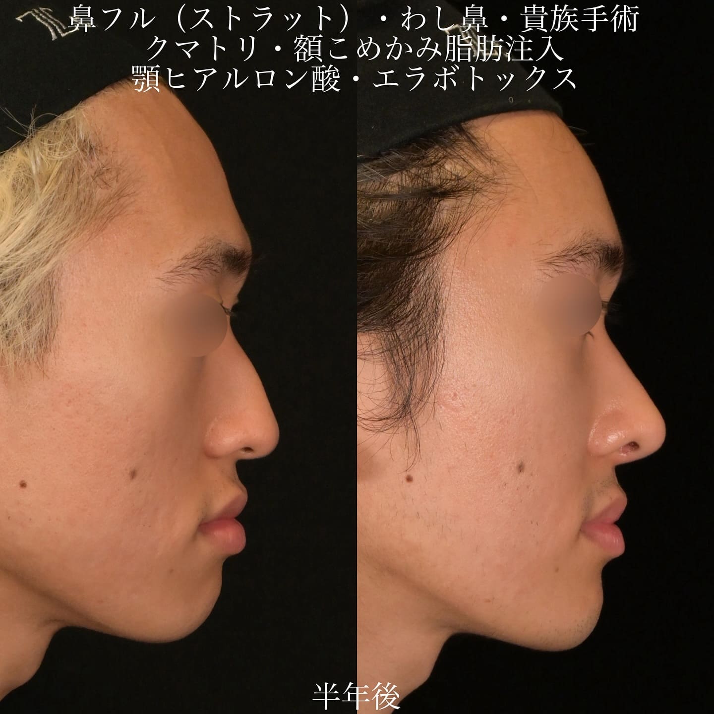 上木原医師による鼻整形の術前/術後6ヶ月 施術後 