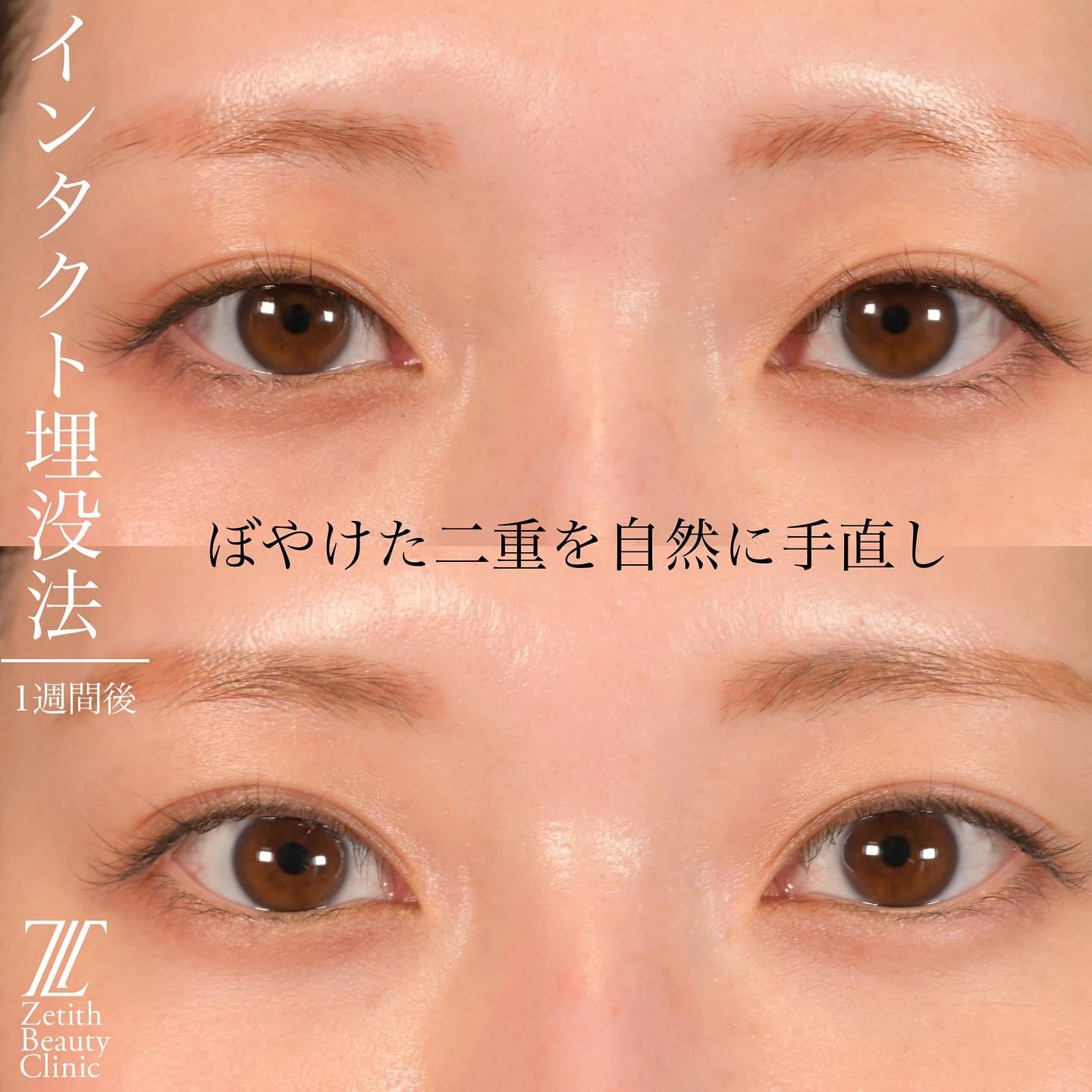 上木原医師による二重整形の術前/術後1週間