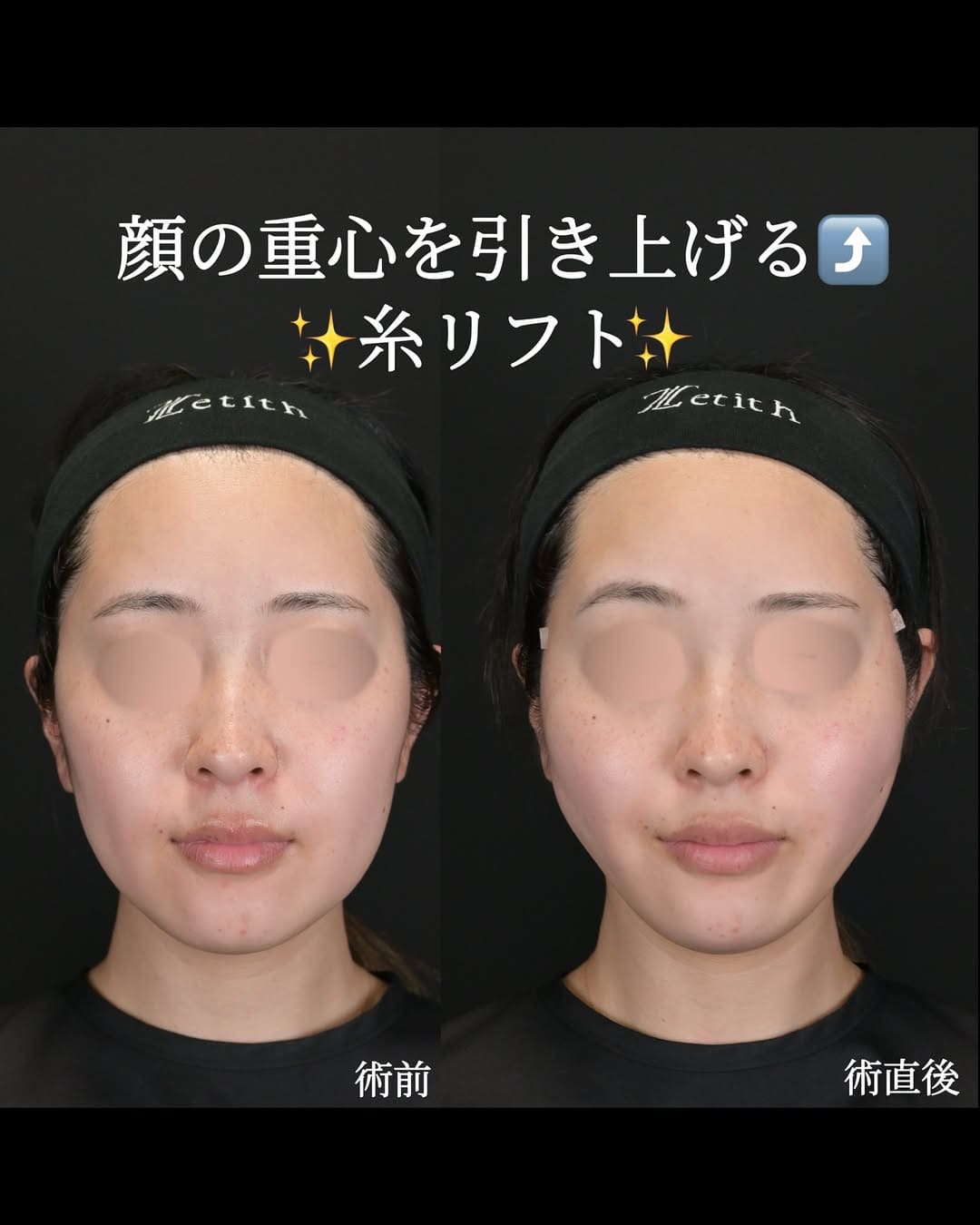沈医師による糸リフトの術前/術後1週間