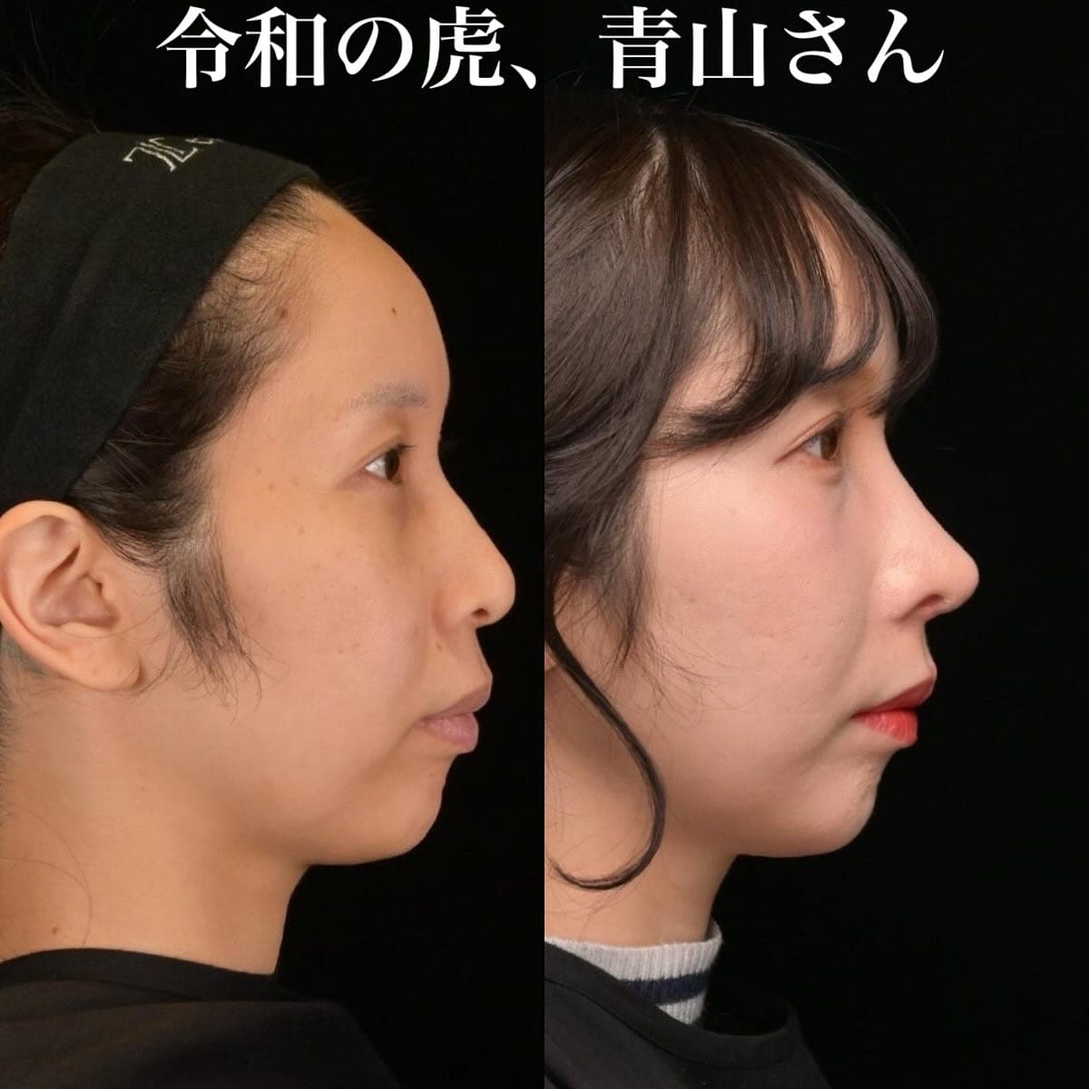 鉄医師による鼻整形の術前/術後5ヶ月 施術後 