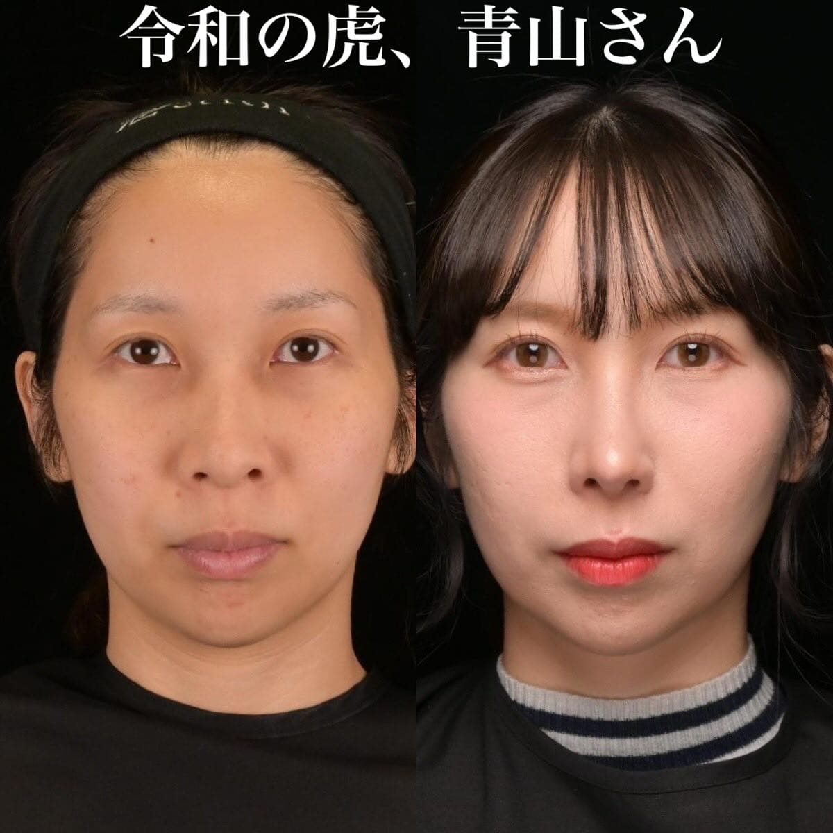 鉄医師による鼻整形の術前/術後5ヶ月