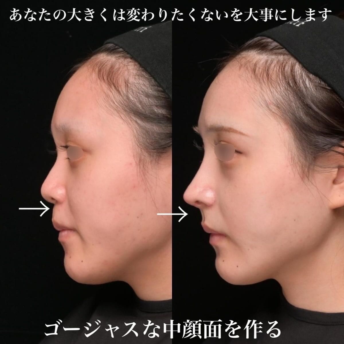 鉄医師による鼻整形の術前/術後1ヶ月 施術後 