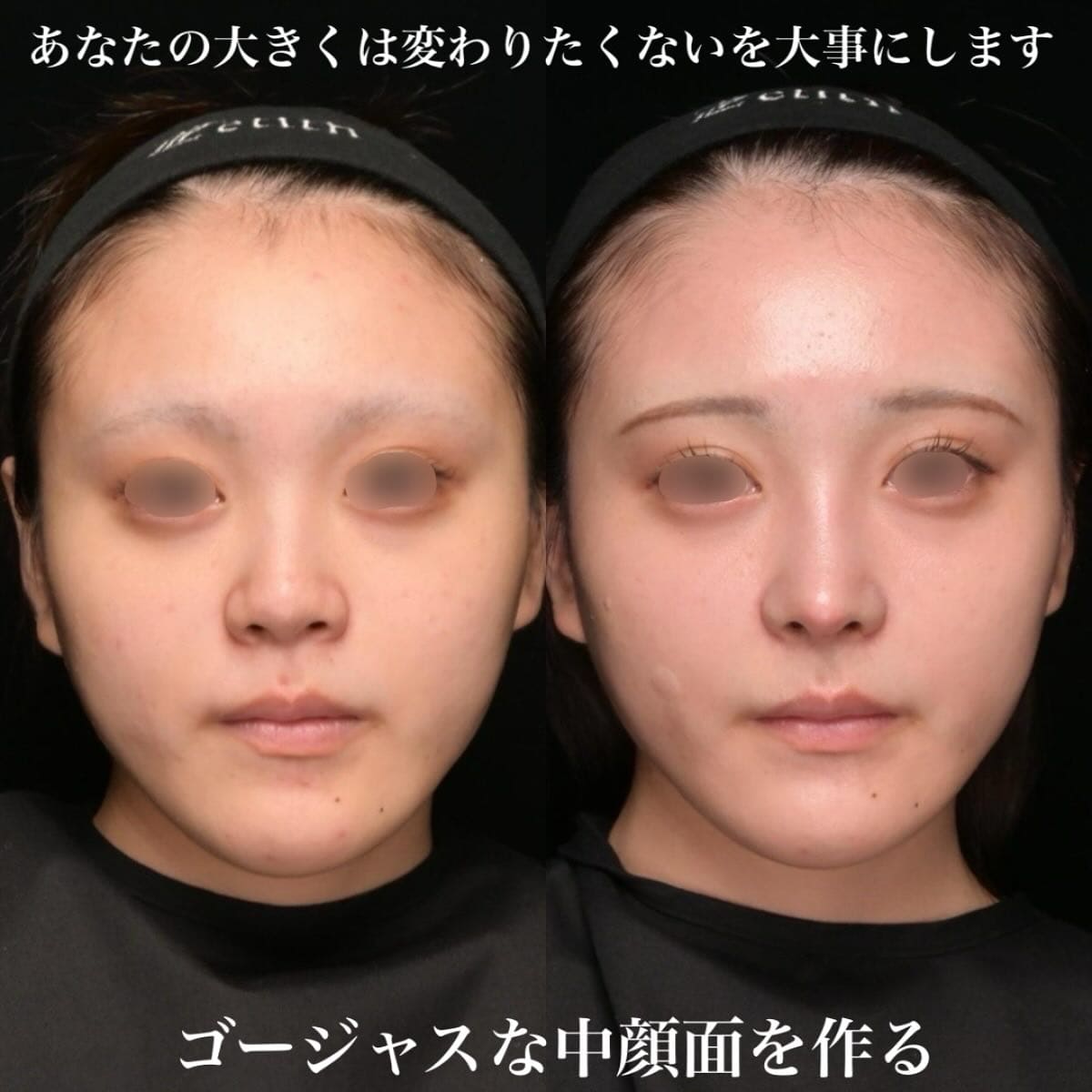 鉄医師による鼻整形の術前/術後1ヶ月