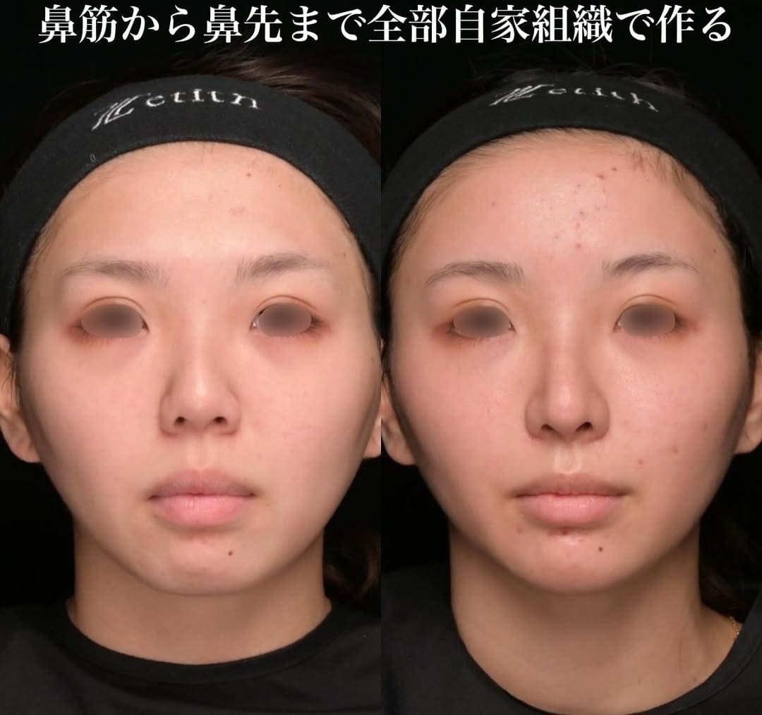 鉄医師による鼻整形の術前/術後ヶ月