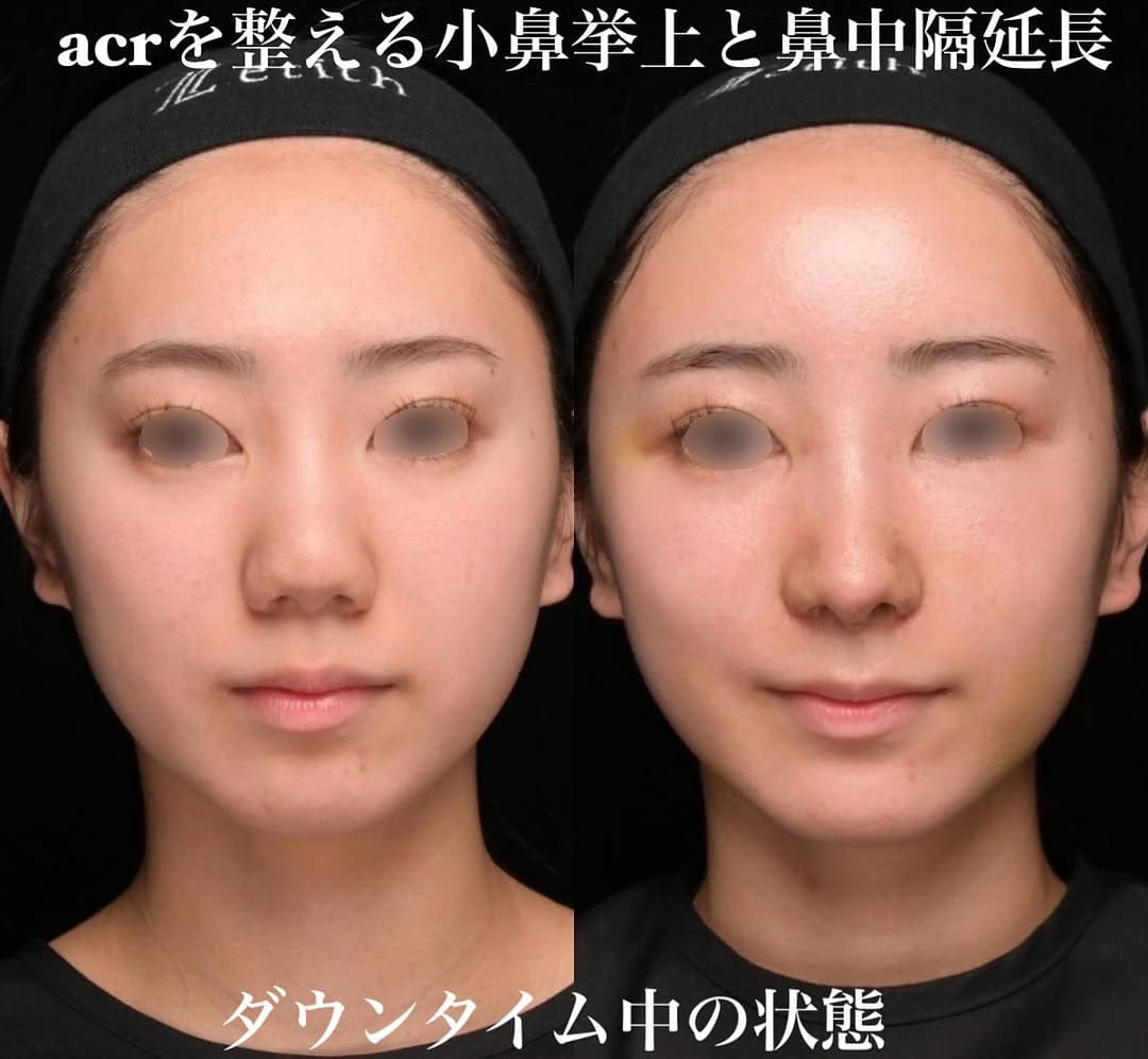 鉄医師による鼻整形の術前/術後2週間