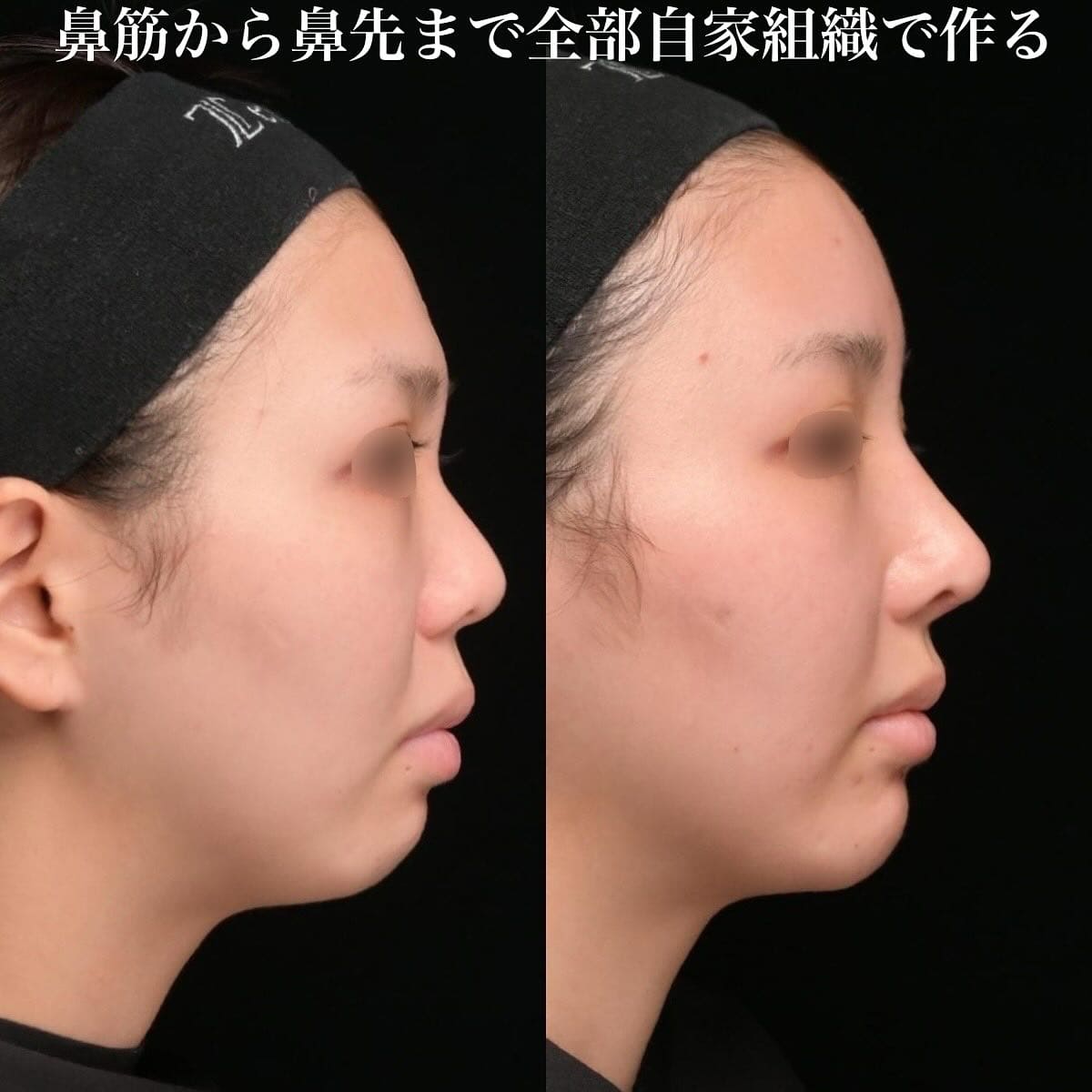 鉄医師による鼻整形の術前/術後ヶ月 施術後 