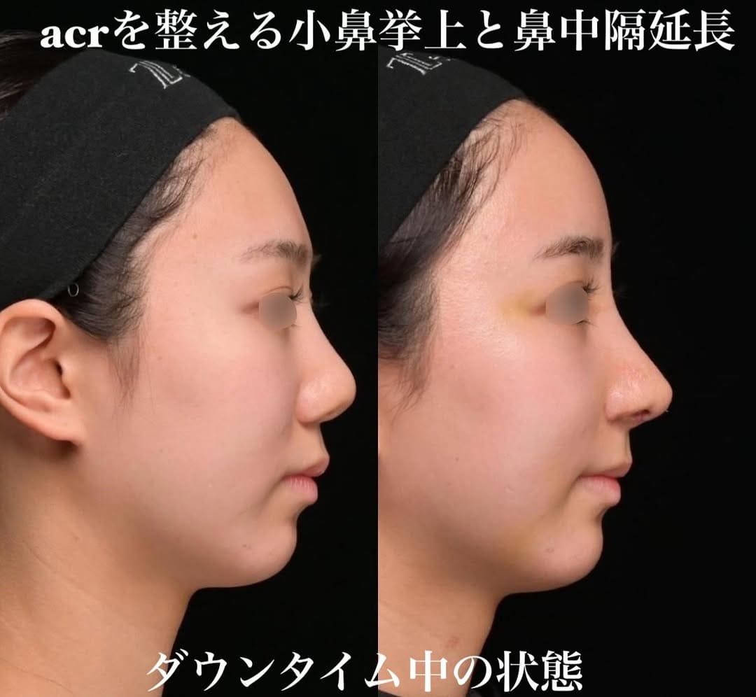 鉄医師による鼻整形の術前/術後2週間 术后 