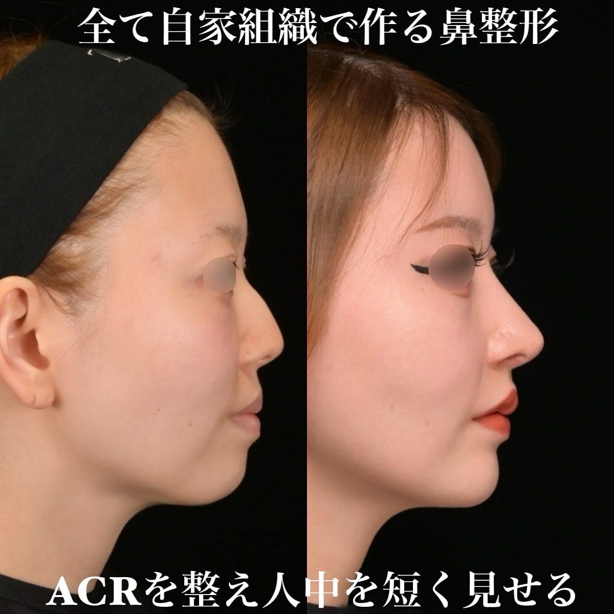鉄医師による鼻整形の術前/術後３ヶ月 Дараа 