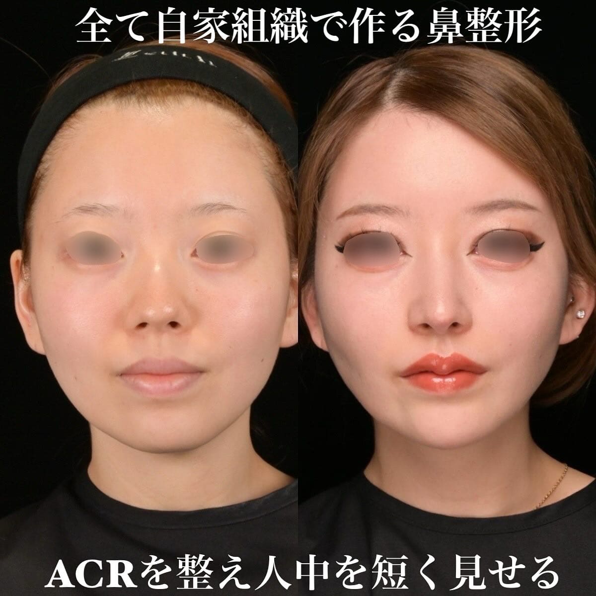 鉄医師による鼻整形の術前/術後３ヶ月