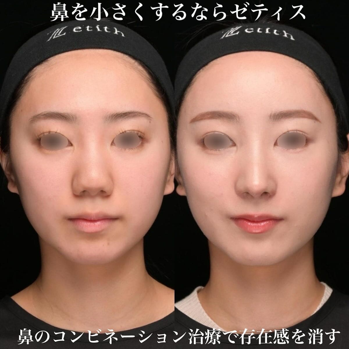 鉄医師による鼻整形の術前/術後１ヶ月