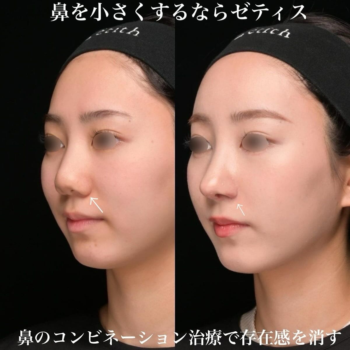 鉄医師による鼻整形の術前/術後１ヶ月 术后 