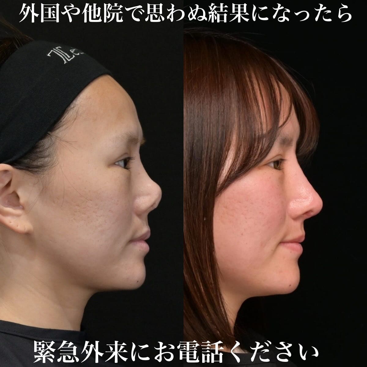 鉄医師による鼻整形の術前/術後6ヶ月 施術後 