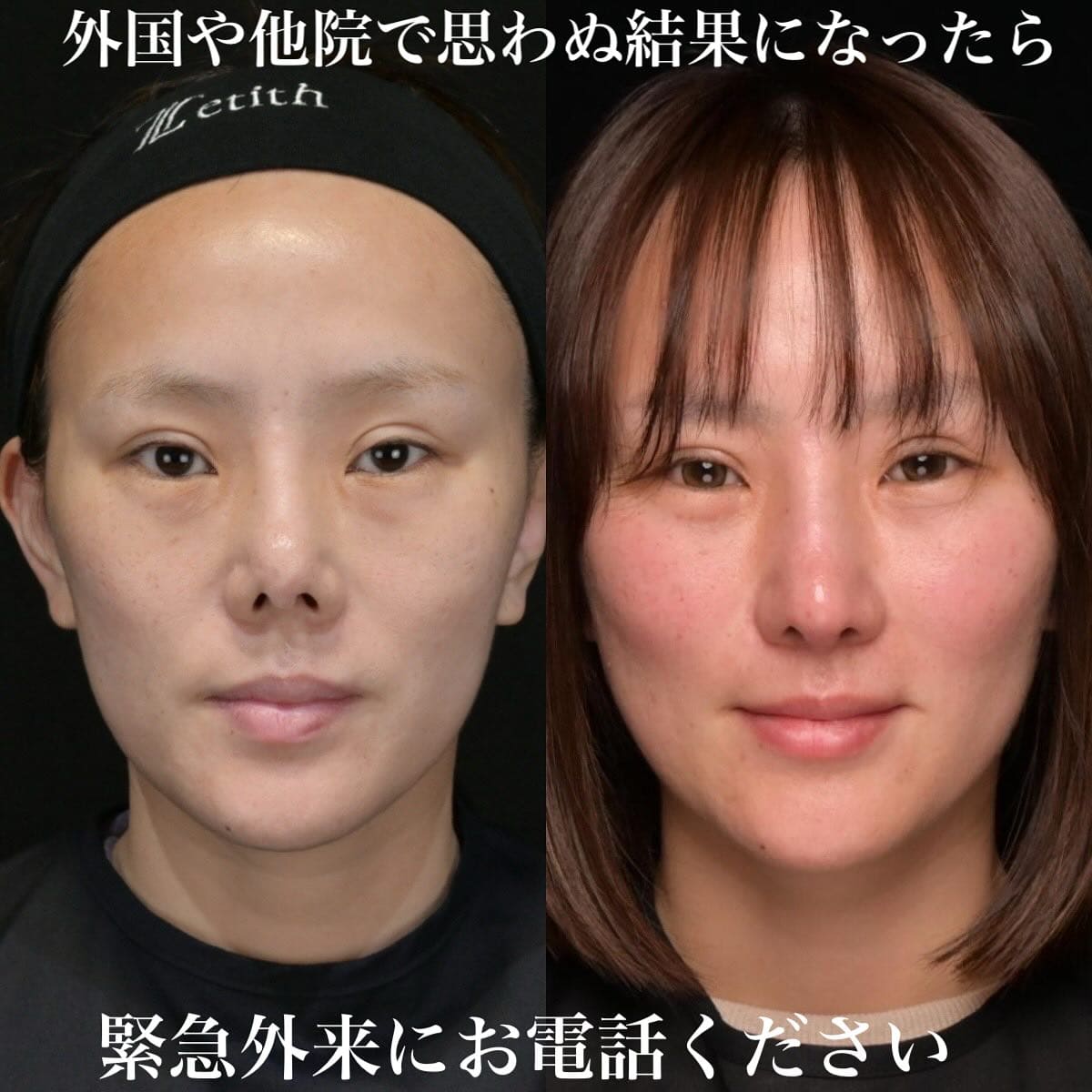鉄医師による鼻整形の術前/術後6ヶ月