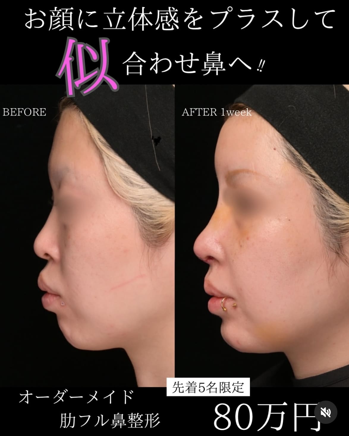 守屋医師による鼻整形の術前/術後1週間後