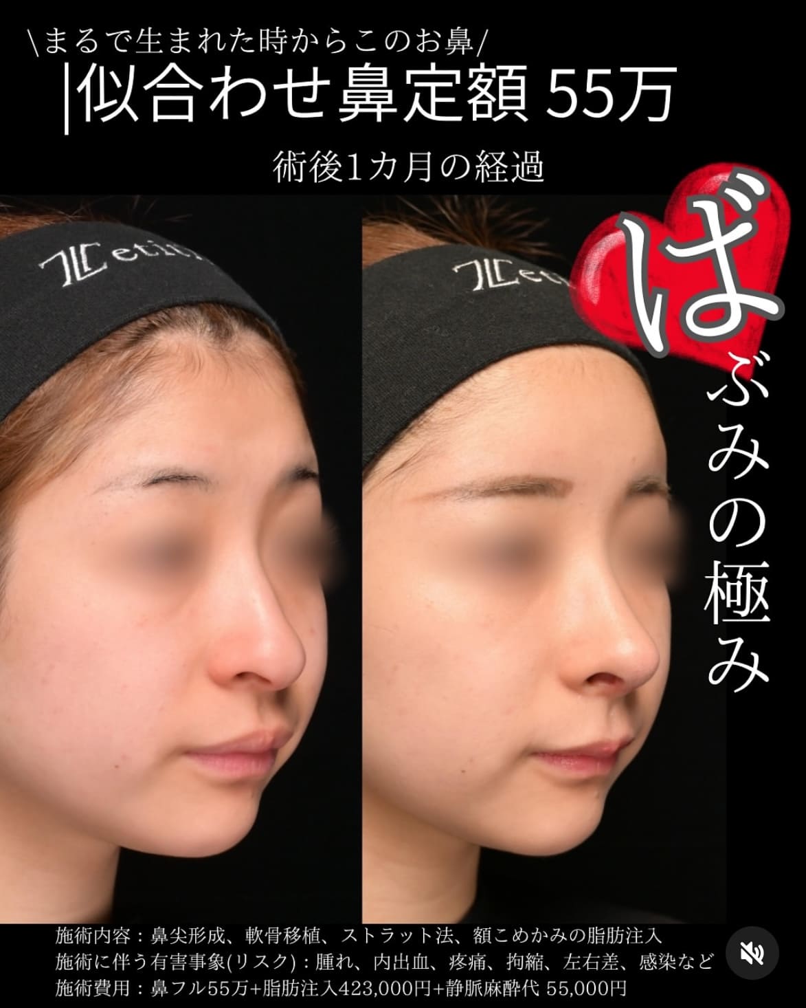 守屋医師による鼻整形の術前/術後1ヶ月