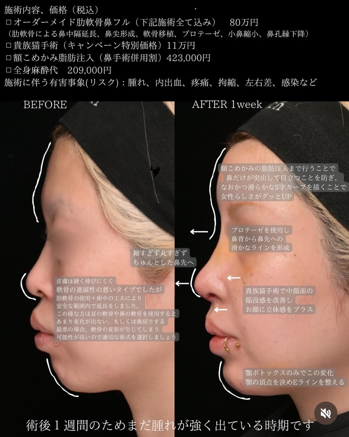 守屋医師による鼻整形の術前/術後1週間後 施術後 