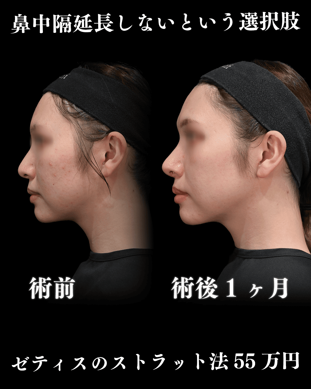 中村医師による鼻整形の術前/術後1ヶ月 施術後 