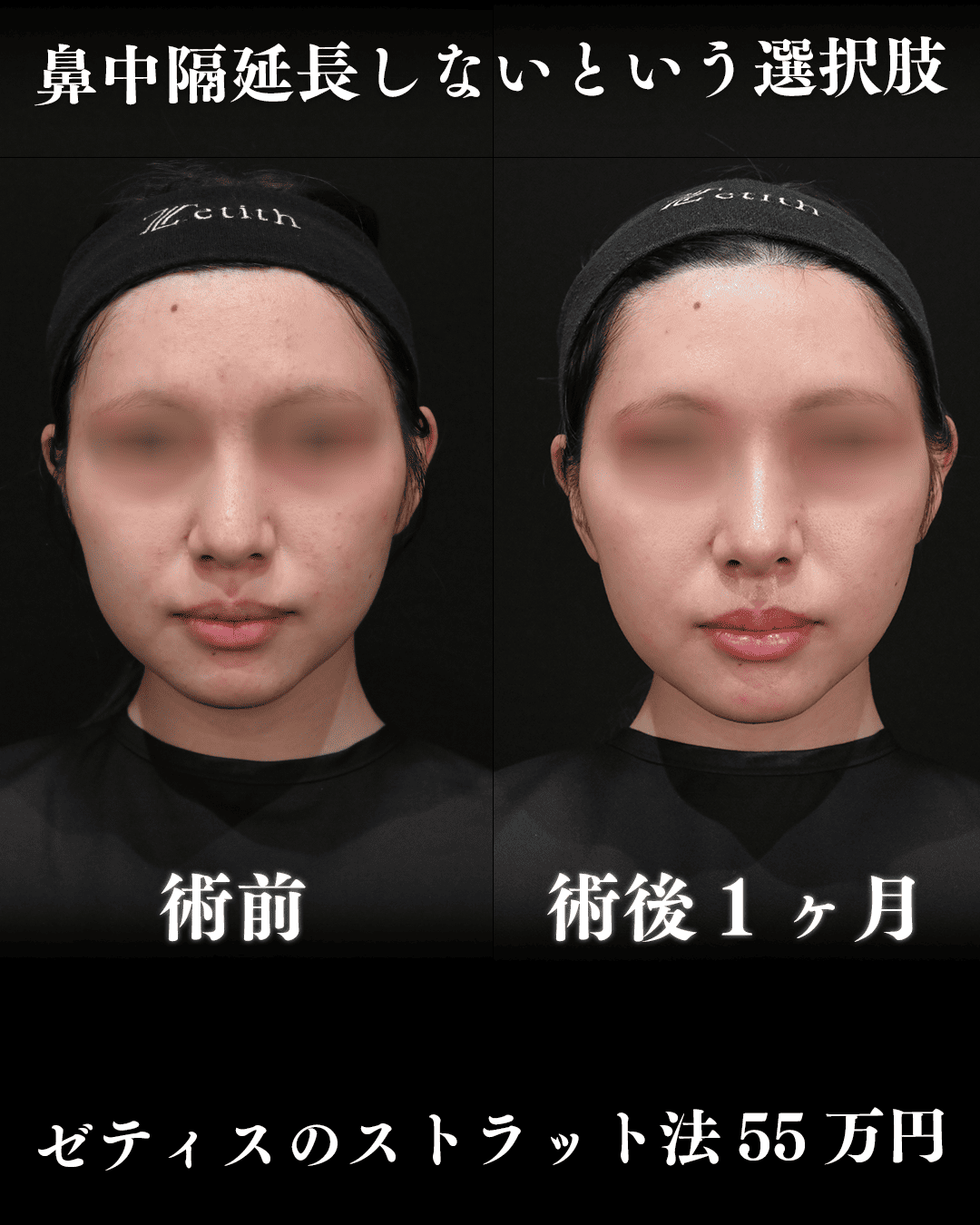 中村医師による鼻整形の術前/術後1ヶ月