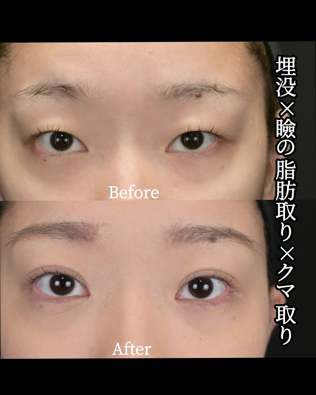 沈医師による目元整形の術前/術後1ヶ月