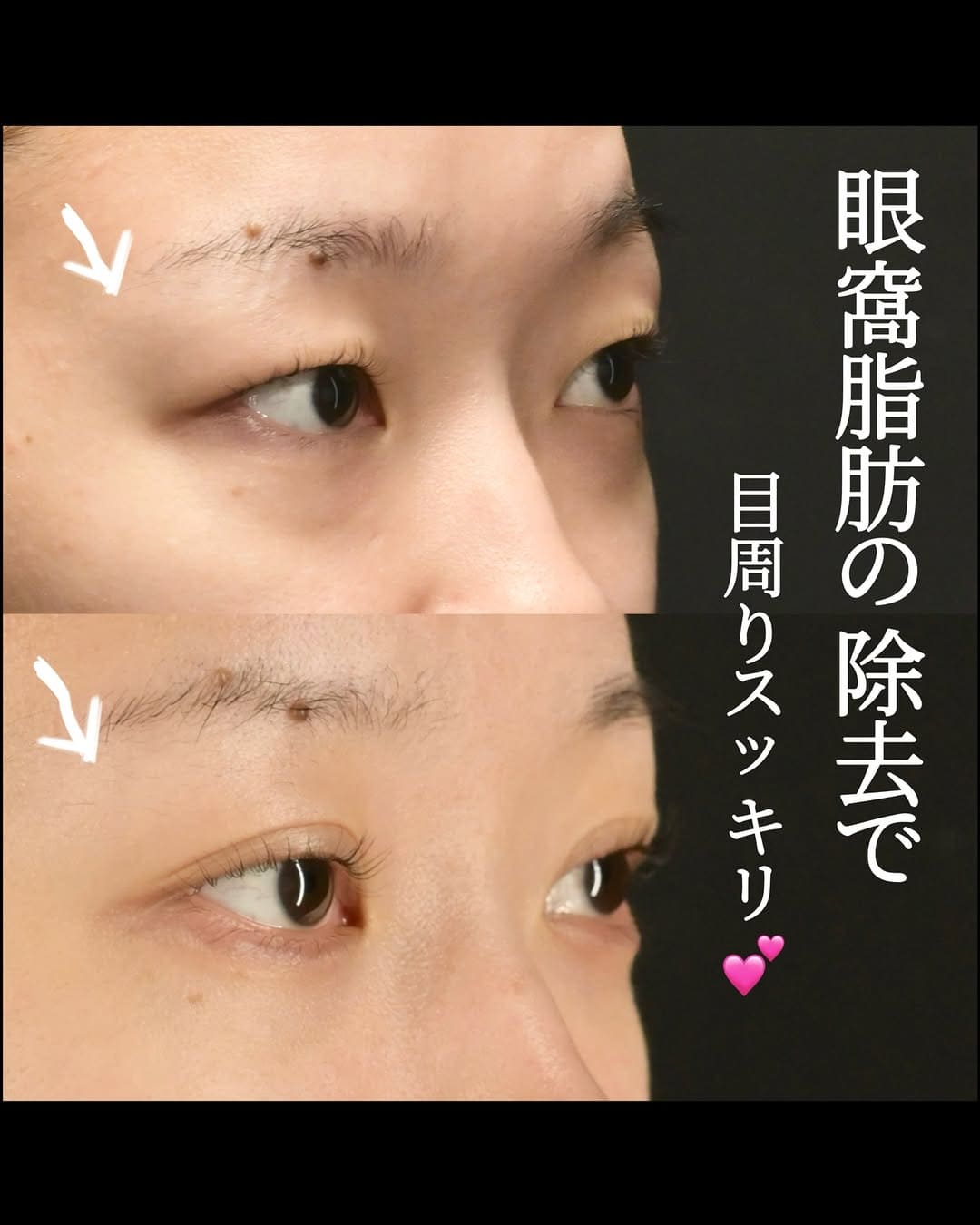 沈医師による目元整形の術前/術後1ヶ月 After 
