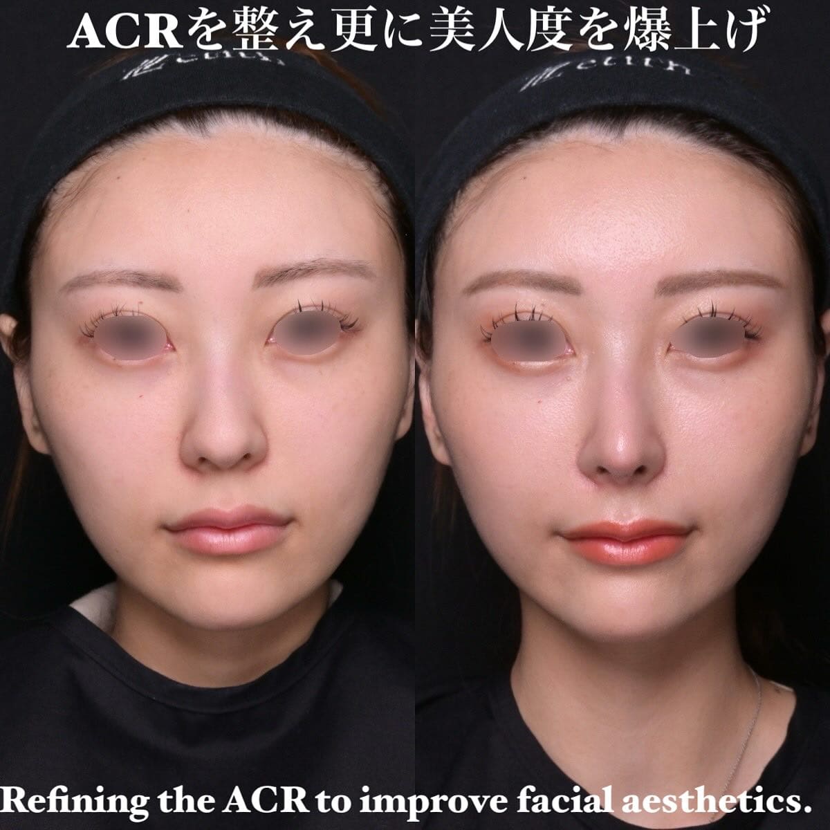 鉄医師による鼻整形の術前/術後1ヶ月