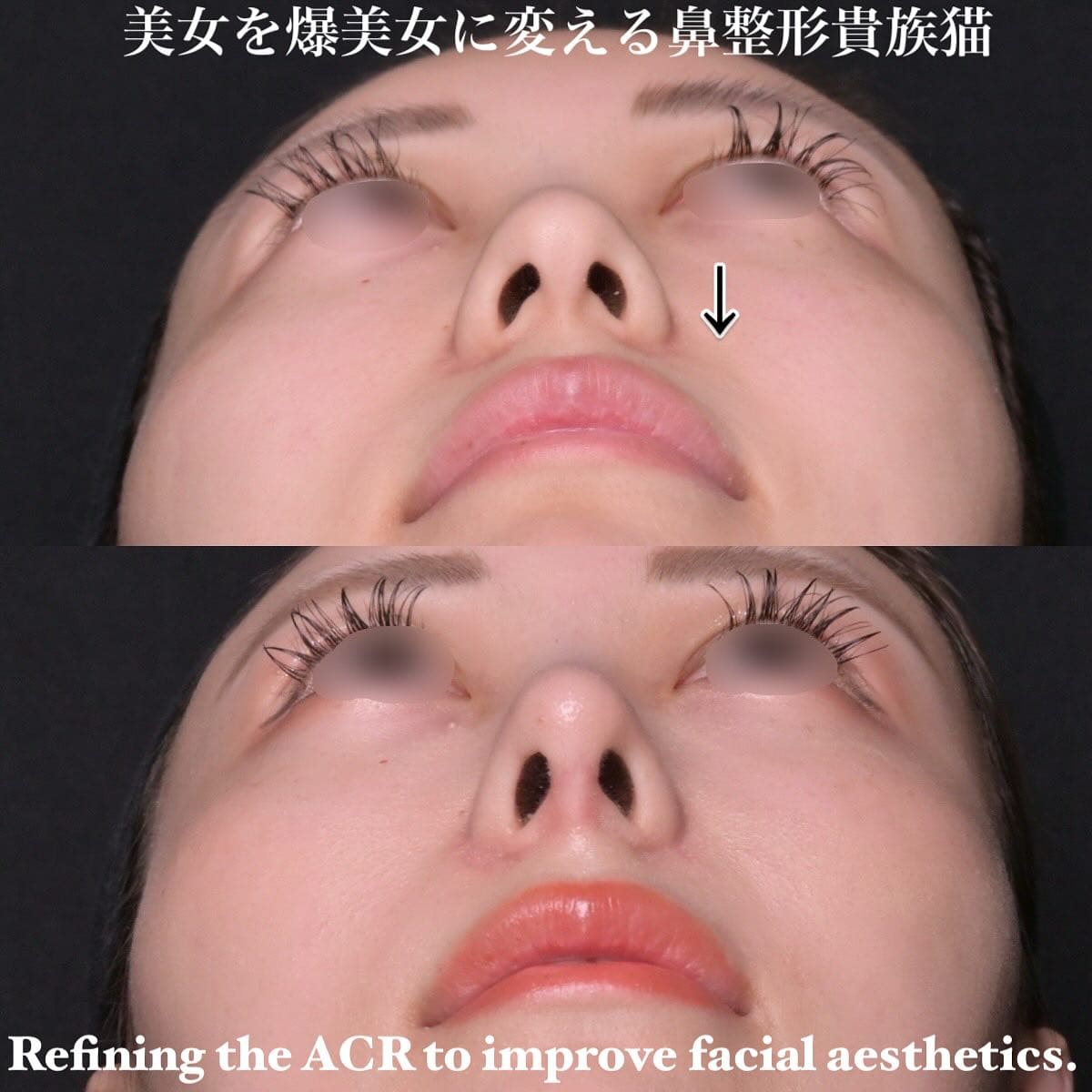 鉄医師による鼻整形の術前/術後1ヶ月 بعد 