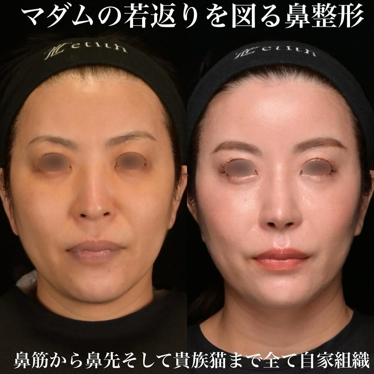 鉄医師による鼻整形の術前/術後３ヶ月