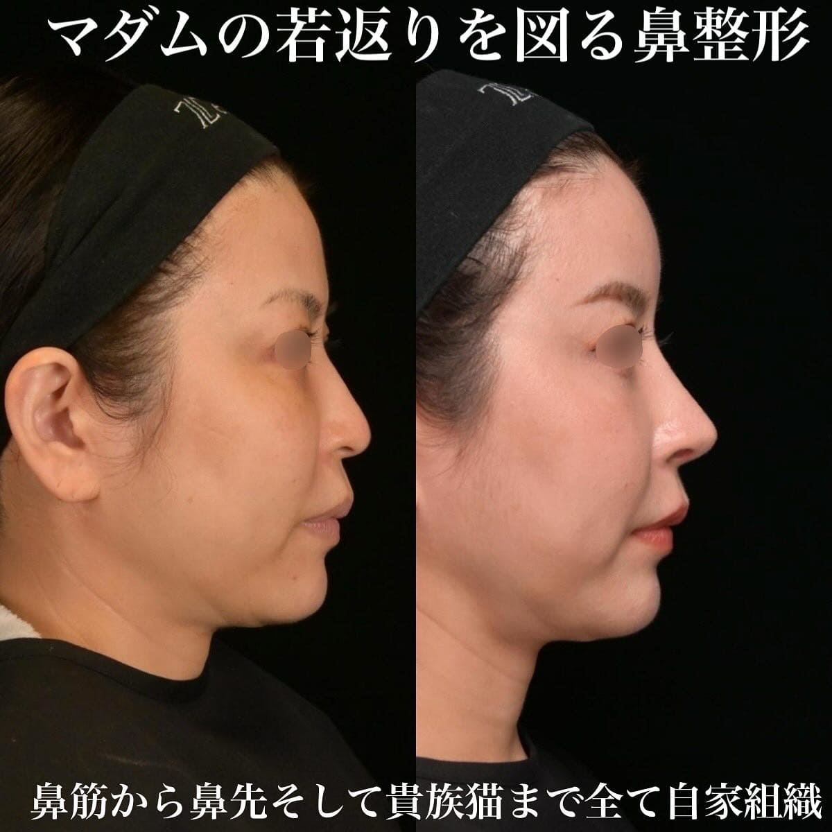 鉄医師による鼻整形の術前/術後３ヶ月 Дараа 
