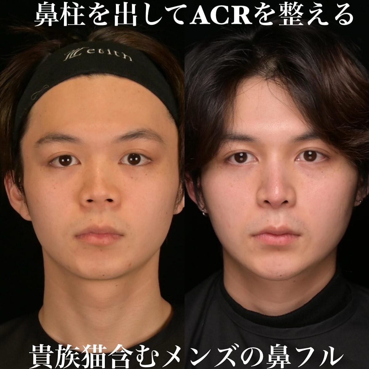 鉄医師による鼻整形の術前/術後6ヶ月