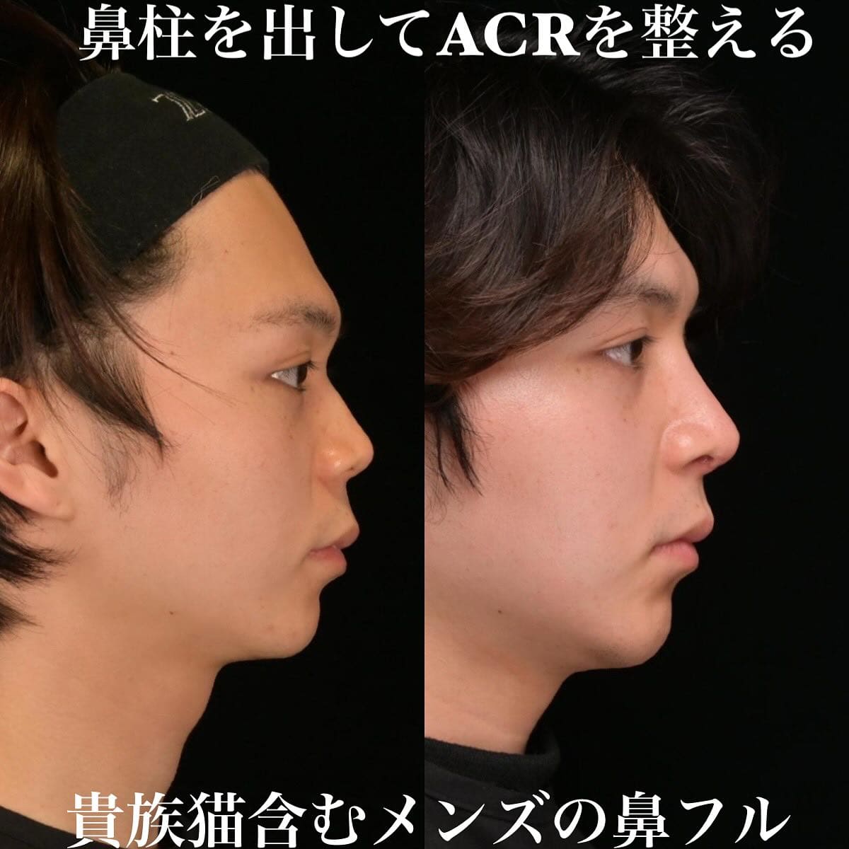 鉄医師による鼻整形の術前/術後6ヶ月 施術後 