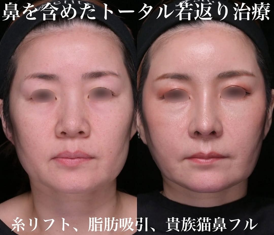 鉄医師による鼻整形の術前/術後1ヶ月