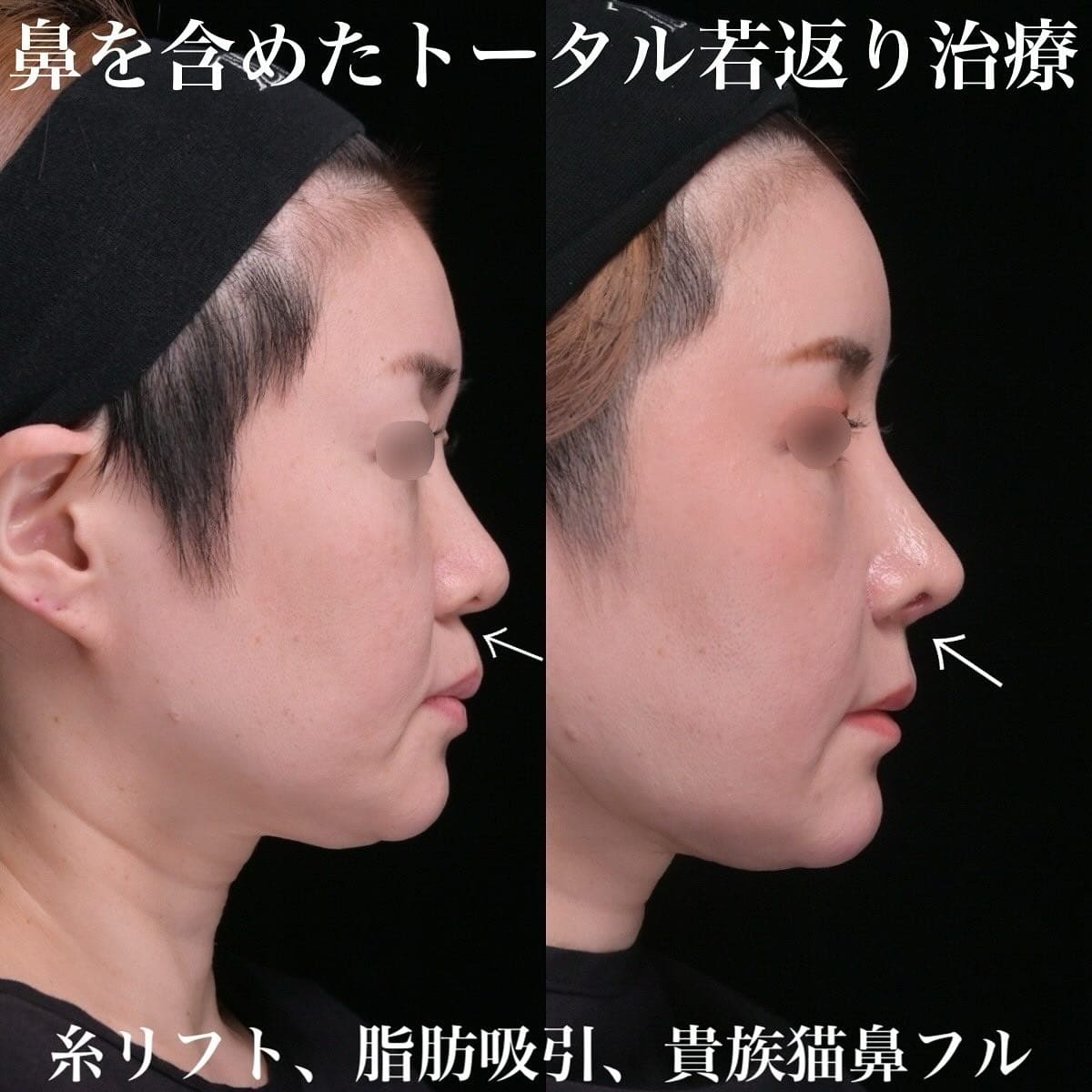 鉄医師による鼻整形の術前/術後1ヶ月 施術後 