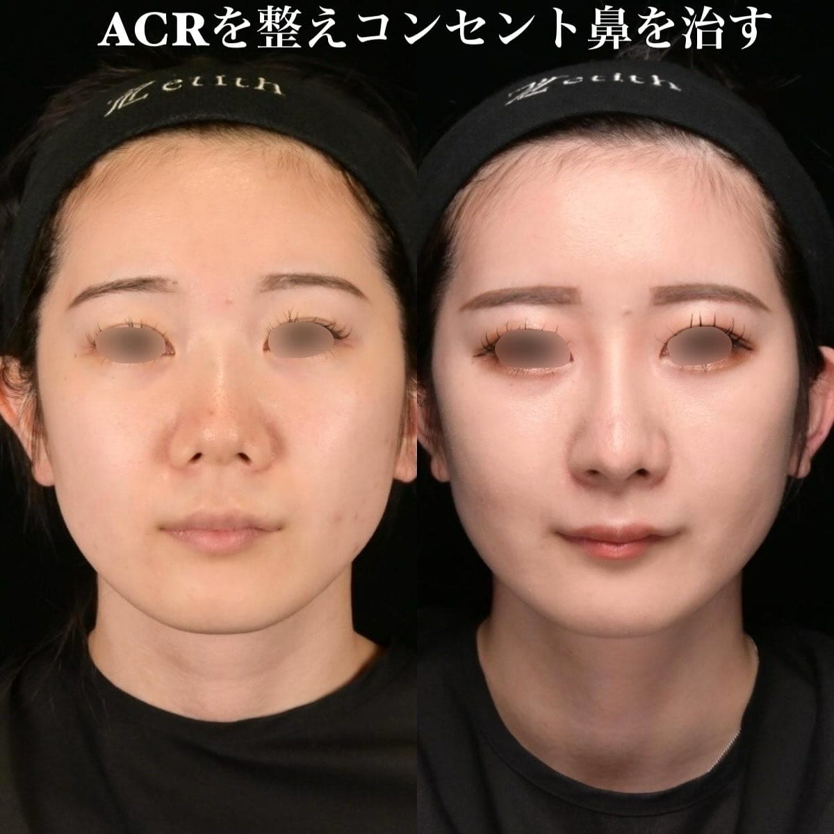 鉄医師による鼻整形の術前/術後３ヶ月