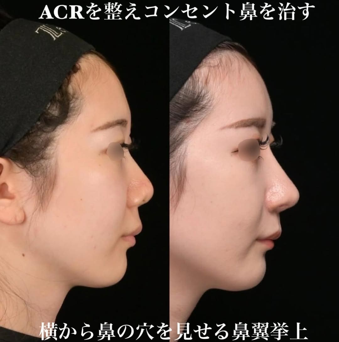 鉄医師による鼻整形の術前/術後３ヶ月 施術後 