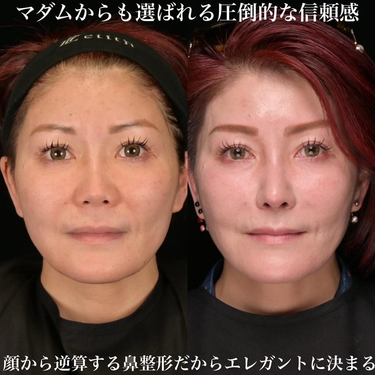 鉄医師による鼻整形の術前/術後３ヶ月