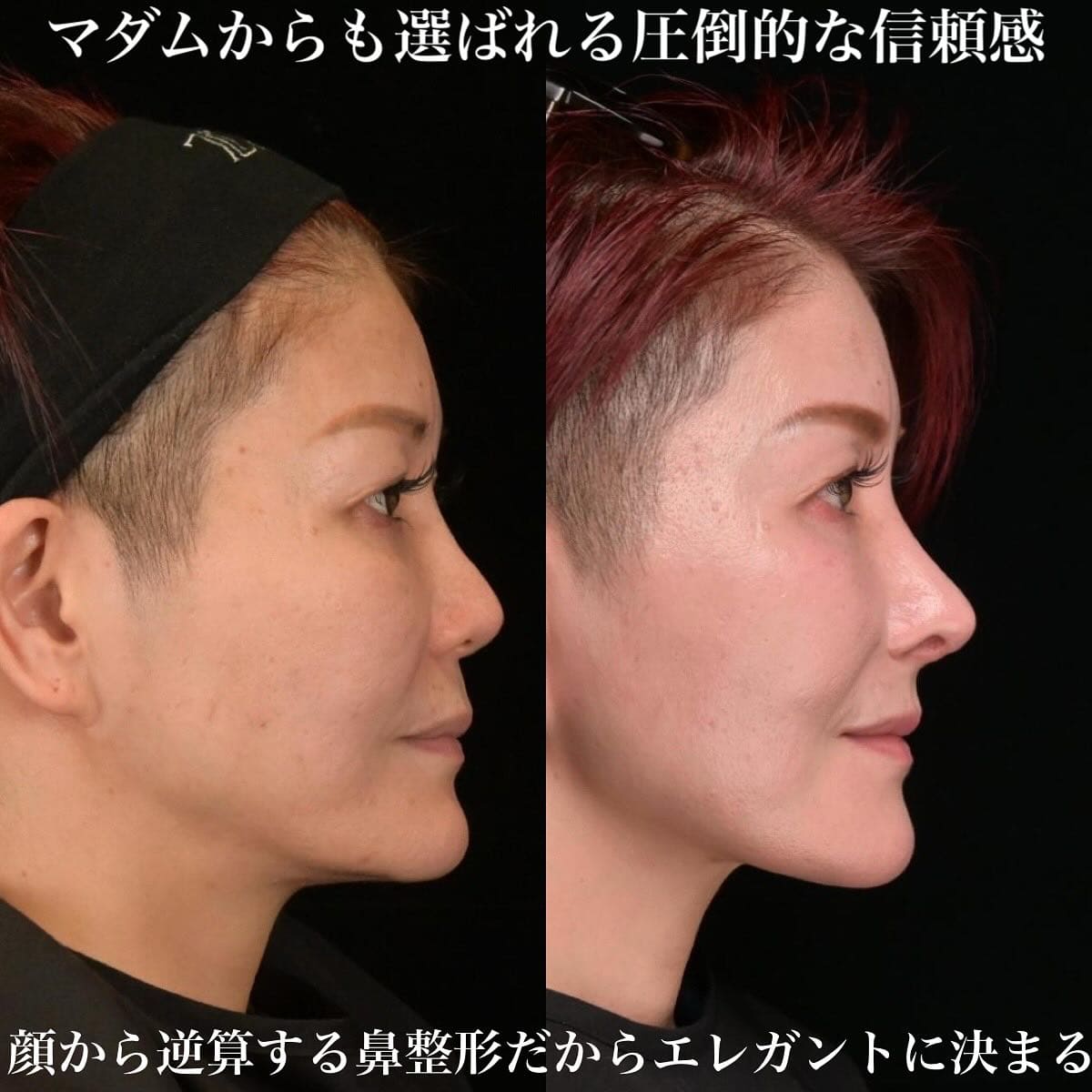 鉄医師による鼻整形の術前/術後３ヶ月 施術後 