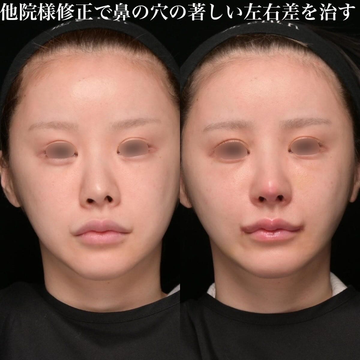 鉄医師による鼻整形の術前/術後３ヶ月